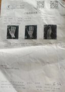 医院被指隐瞒骨折事实致患者身体损害和经济损失